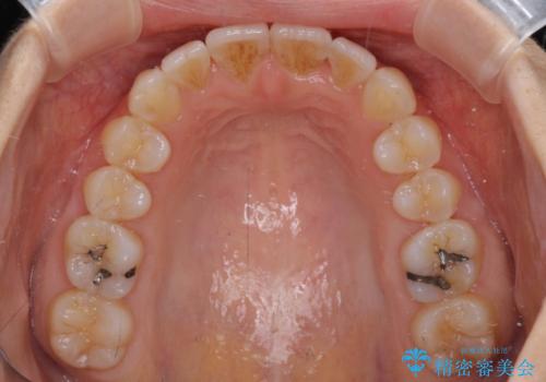 短期間で仕上げたい ワイヤーでの非抜歯矯正の治療後