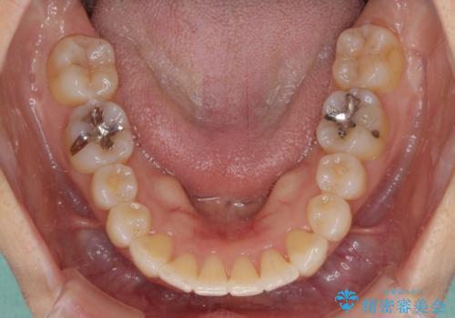短期間で仕上げたい ワイヤーでの非抜歯矯正の治療後