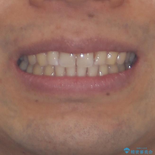 上顎の出っ歯とすきっ歯　補助装置を用いたインビザライン矯正の治療後（顔貌）