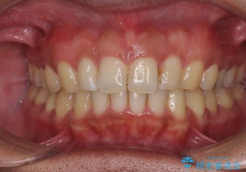 上顎の出っ歯とすきっ歯　補助装置を用いたインビザライン矯正の症例 治療後