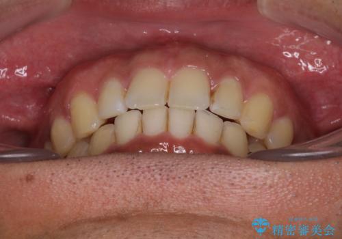 上顎の出っ歯とすきっ歯 補助装置を用いたインビザライン矯正の治療後
