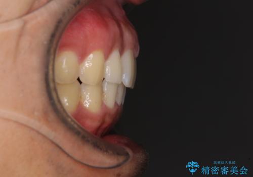 上顎の出っ歯とすきっ歯　補助装置を用いたインビザライン矯正の治療後