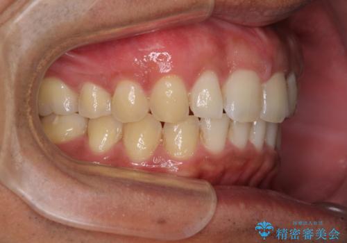 上顎の出っ歯とすきっ歯 補助装置を用いたインビザライン矯正の治療後