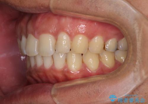 上顎の出っ歯とすきっ歯 補助装置を用いたインビザライン矯正の治療後