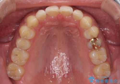 上顎の出っ歯とすきっ歯 補助装置を用いたインビザライン矯正の治療後