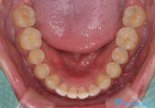 上顎の出っ歯とすきっ歯 補助装置を用いたインビザライン矯正の治療後