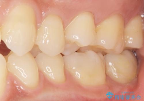 奥歯にフロスを通すと臭い 30代女性の治療後