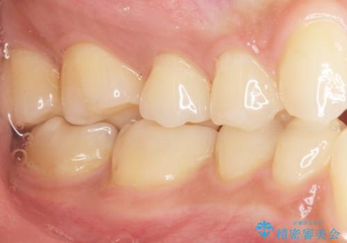 奥歯にフロスを通すと臭い 30代女性の治療後