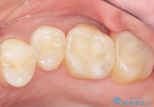 奥歯にフロスを通すと臭い 30代女性の治療後