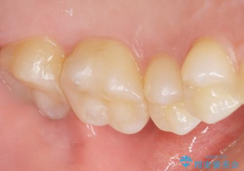 奥歯にフロスを通すと臭い 30代女性の治療後
