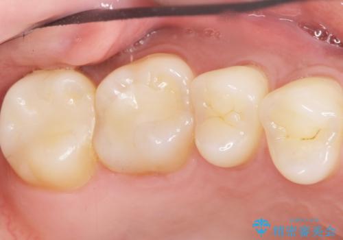 奥歯にフロスを通すと臭い 30代女性の治療後