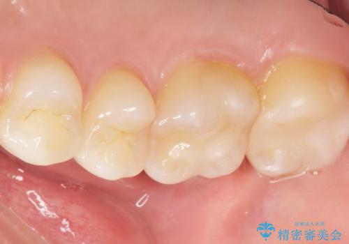 奥歯にフロスを通すと臭い 30代女性の治療後