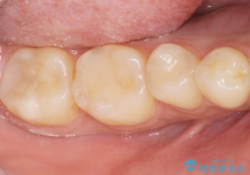 奥歯にフロスを通すと臭い 30代女性の治療後