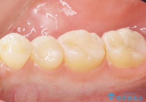 奥歯にフロスを通すと臭い 30代女性の治療後