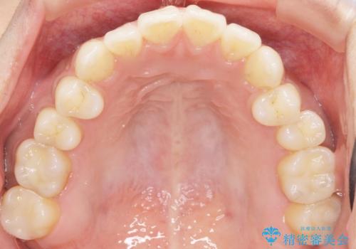 奥歯にフロスを通すと臭い 30代女性の治療後