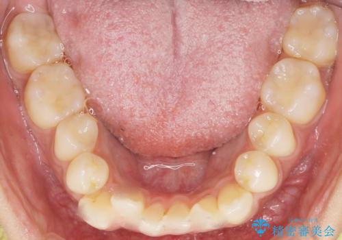 奥歯にフロスを通すと臭い 30代女性の治療後