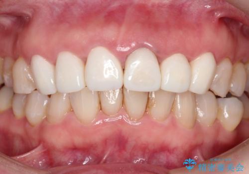 被せ物に合わせて歯を白くしたい