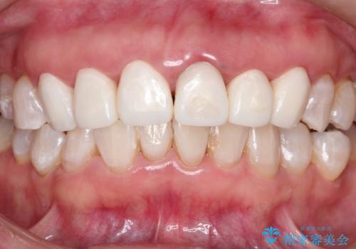 被せ物に合わせて歯を白くしたいの症例 治療後