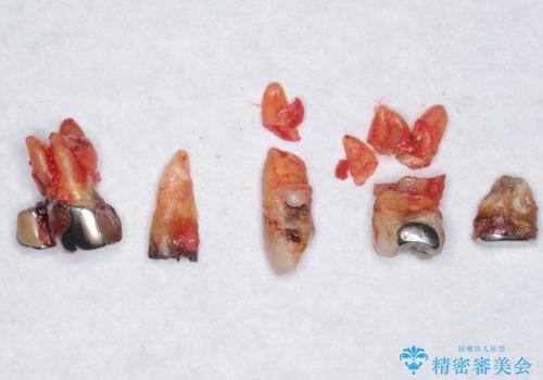 交通事故で前歯が折れた マグネットデンチャー 50代男性の治療中