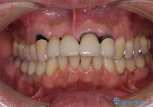 話しにくく見栄えの悪い前歯 オールセラミックブリッジの治療前
