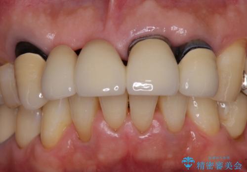 話しにくく見栄えの悪い前歯 オールセラミックブリッジの治療前