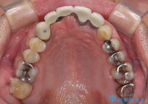 話しにくく見栄えの悪い前歯 オールセラミックブリッジの治療前