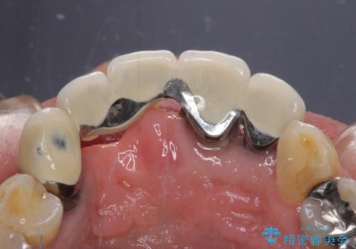 話しにくく見栄えの悪い前歯 オールセラミックブリッジの治療前