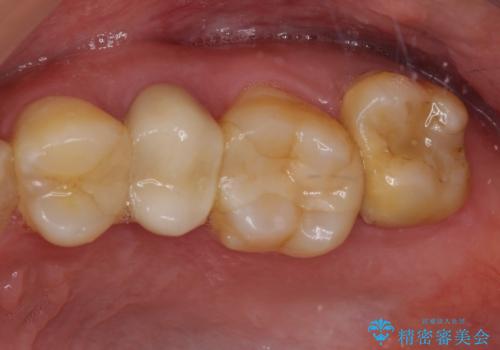 冷たいものがしみる 神経組織の一部を除去した虫歯治療の症例 治療前