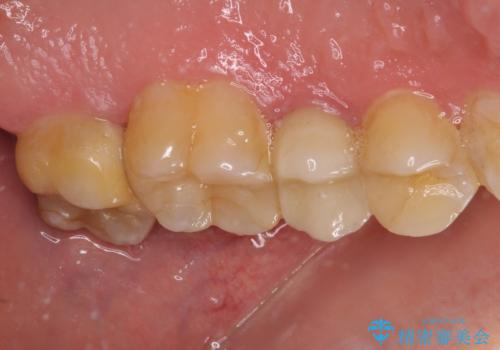 冷たいものがしみる 神経組織の一部を除去した虫歯治療の治療前