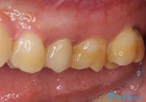 冷たいものがしみる 神経組織の一部を除去した虫歯治療の治療前