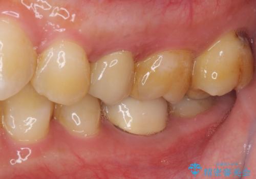 冷たいものがしみる 神経組織の一部を除去した虫歯治療の治療前