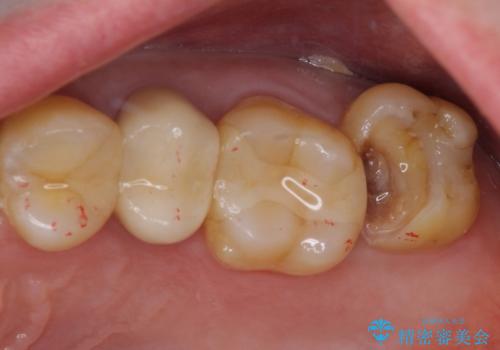 冷たいものがしみる 神経組織の一部を除去した虫歯治療の治療中