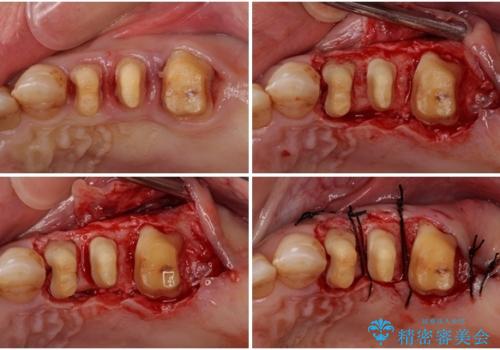 歯列不正と歯周病 総合歯科治療による全顎治療の治療中