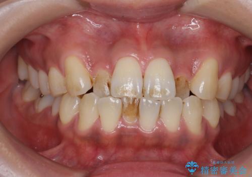 PMTCで歯の表面の着色をきれいに除去。の治療前