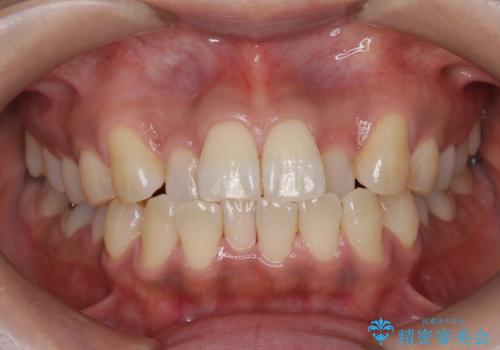 PMTCで歯の表面の着色をきれいに除去。