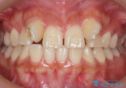 歯の位置異常 はやく治したい 矯正は嫌 20代女性の治療前