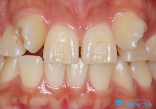 歯の位置異常 はやく治したい 矯正は嫌 20代女性の治療前