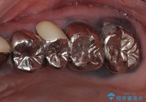 目立つ銀色の奥歯をセラミックに セラミックブリッジの症例 治療前