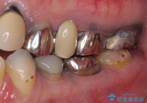 目立つ銀色の奥歯をセラミックに　セラミックブリッジの治療前