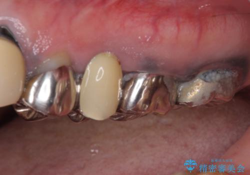 目立つ銀色の奥歯をセラミックに　セラミックブリッジの治療前