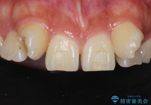 歯の位置異常 はやく治したい 矯正は嫌 20代女性の治療前