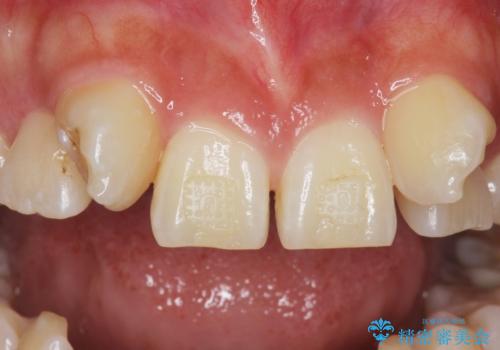 歯の位置異常　はやく治したい　矯正は嫌　20代女性の治療前