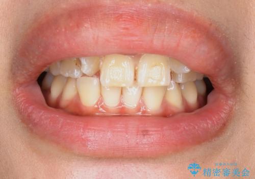 歯の位置異常 はやく治したい 矯正は嫌 20代女性の治療前