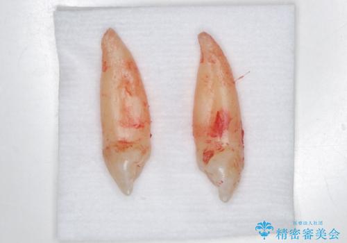 歯の位置異常 はやく治したい 矯正は嫌 20代女性の治療中