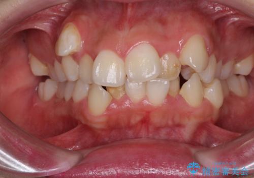 著しい叢生と顎骨のズレ　ワイヤー装置による抜歯矯正の症例 治療前