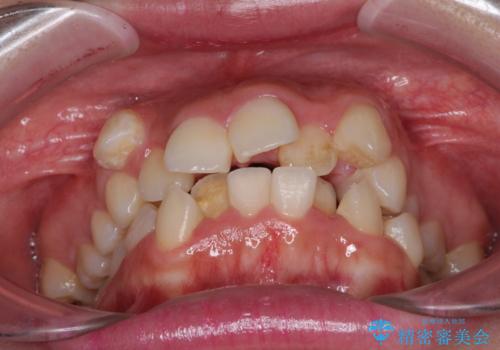 著しい叢生と顎骨のズレ　ワイヤー装置による抜歯矯正の治療前