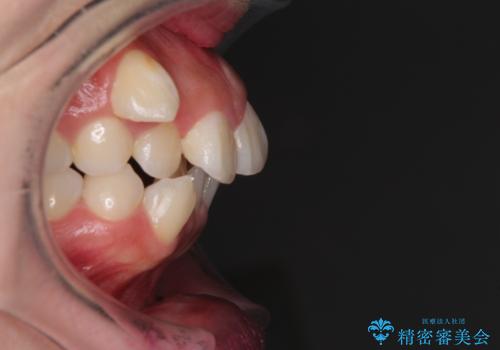 著しい叢生と顎骨のズレ　ワイヤー装置による抜歯矯正の治療前