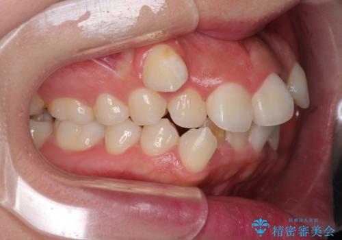 著しい叢生と顎骨のズレ ワイヤー装置による抜歯矯正の治療前