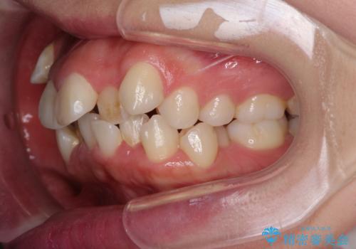 著しい叢生と顎骨のズレ ワイヤー装置による抜歯矯正の治療前