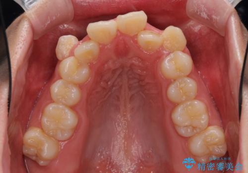 著しい叢生と顎骨のズレ ワイヤー装置による抜歯矯正の治療前